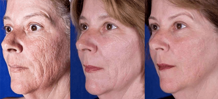 Resultado después del rejuvenecimiento de la piel facial con láser