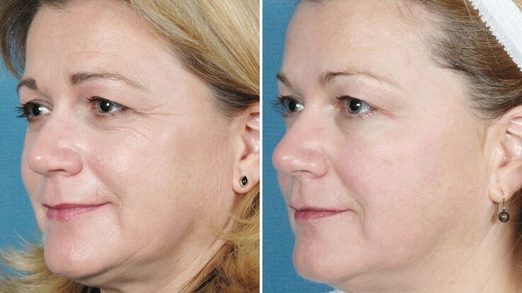 Fotos antes y después del rejuvenecimiento de la piel. 