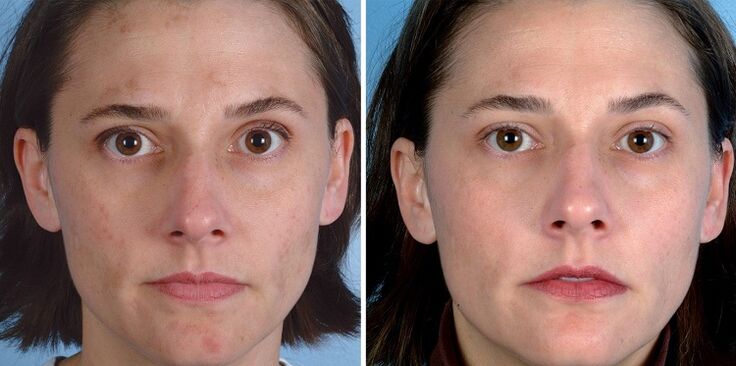 antes y después del rejuvenecimiento de la piel con el dispositivo