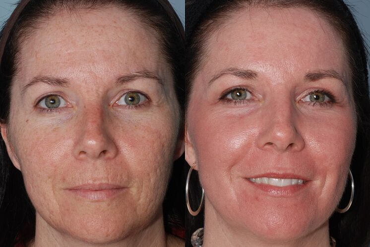 antes y después del rejuvenecimiento de la piel