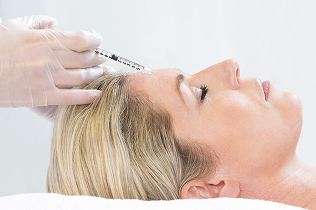 El plasmolifting es un método de inyección para rejuvenecer la piel del rostro