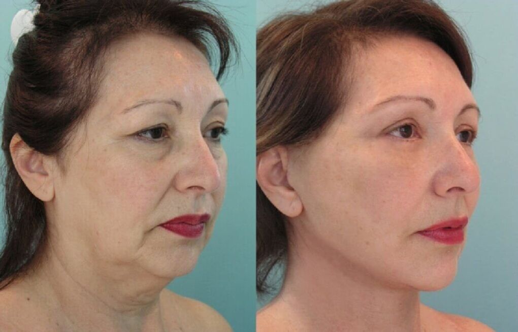 Foto antes y después del rejuvenecimiento de la piel. 